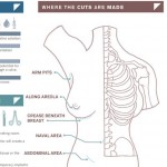 breastaugmentation-thumb